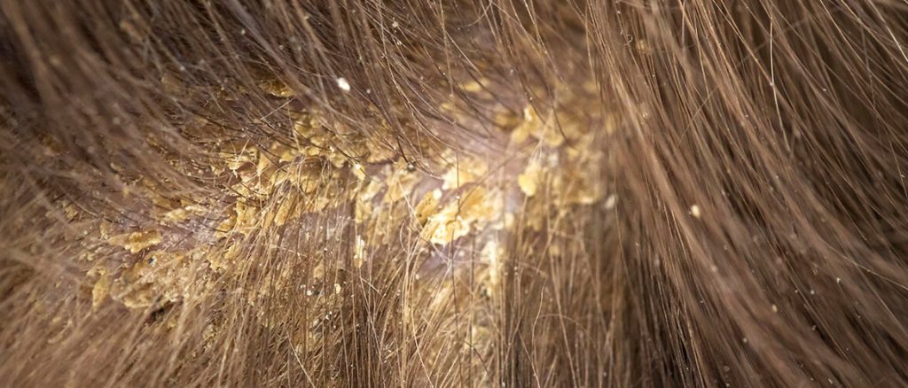 What Are The Good Ways To Cure Scalp Fungus? | CLOCIP - Cipla